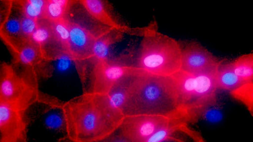 Inmunoterapia avanza en batalla contra cáncer de mama
