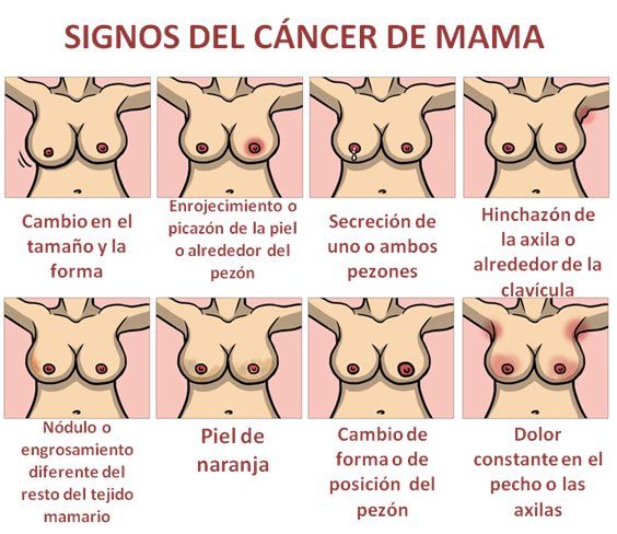 Pasos sencillos para luchar contra el cáncer de mama