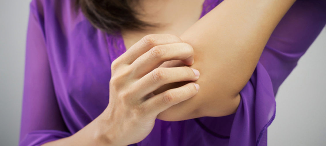 Pacientes con dermatitis atópica tienden a esconderla